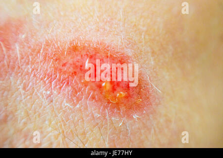 Abrieb. Tiefe Wunde auf der Haut. Tiefe Kratzer auf der Haut mit blauen Flecken und nassen Spuren Stockfoto