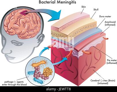 Gehirn, Meningitis, Schädel, Blut, Kopfschmerzen, Viren, Therapie, Fieber, Gehirn, Stock Vektor