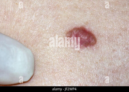 Das Basalzellkarzinom - von einem Arzt untersucht Stockfoto