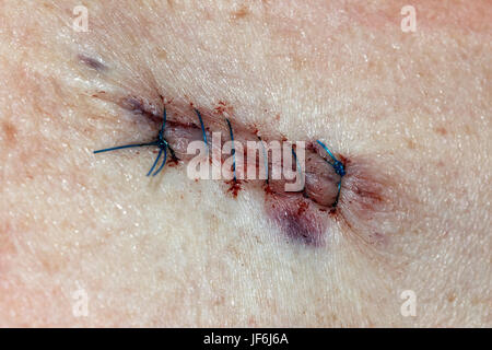 Basalzell-Karzinom - Post operative Stiche. Stockfoto