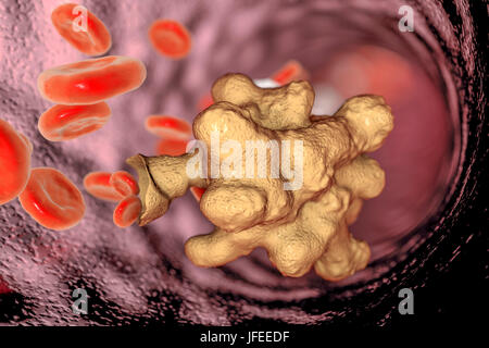 Parasitäre Amöbe (Entamoeba Histolytica) in ein Blutgefäß, Computer Bild. Diese einzelligen Organismus verursacht Amöbenruhr und Geschwüre (vegetative Trophozoite Stadium). Es breitet sich durch fäkale Kontamination von Lebensmitteln und Wasser und ist am häufigsten, wo Hygiene schlecht ist. Amöben können dringen in den Darm aber auf die Leber, Lunge und anderen Geweben. Infektion verursacht durch die Einnahme von Zysten, die in der pathogenen Trophozoite Amöbe hier gesehen zu entwickeln. Entamoeba Histolytica tritt weltweit, mit bis zu 50 % der Bevölkerung, vor allem in den wärmeren Klimata infiziert. Stockfoto