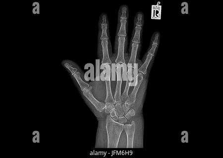 Negative X-ray Bild der menschlichen Hand Rheuma Stockfoto