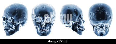 3D CT-Scan des menschlichen Schädels. Mehrere anzeigen. Farbstil zu invertieren. Stockfoto