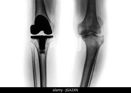 Roentgenfilm Arthrose Knie geduldig und künstlichen Gelenk (Knie-Totalprothese). Isolierte Hintergrund. Stockfoto