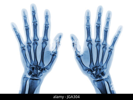 Sowohl der Roentgenfilm hand AP zeigen normale menschliche Hände auf weißem Hintergrund (isoliert) Stockfoto