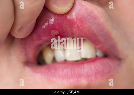 Nahaufnahme von Stomatitis in Mund Stockfoto