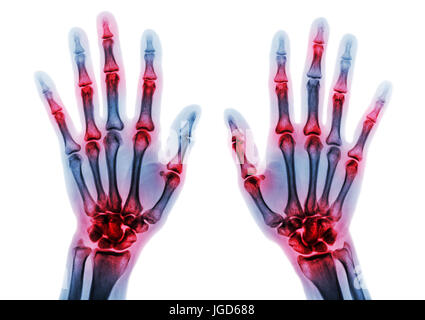 Arthritis mehrere Gelenk der Finger. Film-Röntgen der Hände und Handgelenke. Stockfoto