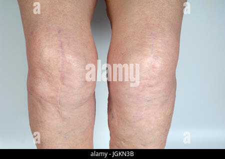 Narbe am Knie von einer älteren Frau, Stockfoto