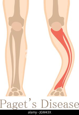 Paget-Krankheit-Symbol, Cartoon-Stil Stock Vektor