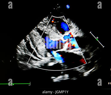 Flow Farbe Modus Show Jet von Aorten- und mitral Ventil regurgitation Stockfoto