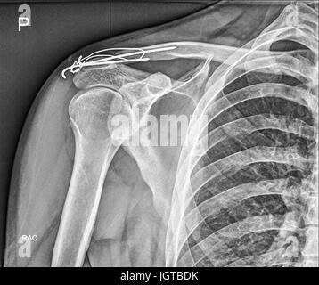 Gebrochenen Schlüsselbein Knochen, Schulter medizinische Xray, Patientenbehandlung Stockfoto