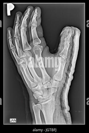 Orthopädische cast auf einem Patienten Hand, Daumen, Finger Joints fixieren Stockfoto