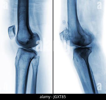 Vergleich zwischen normalen menschlichen Knie (linkes Bild) und Arthrose Knie (rechtes Bild). Seitliche Ansicht. Stockfoto