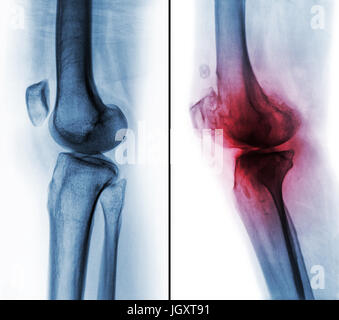 Vergleich zwischen normalen menschlichen Knie (linkes Bild) und Arthrose Knie (rechtes Bild). Seitliche Ansicht. Stockfoto