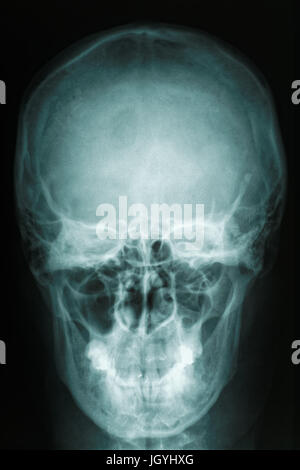 Röntgen Sie Schädel der Frau als Radiographie Film, medizinisches Konzept, schwarzer Hintergrund, Vorderansicht Stockfoto