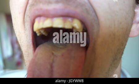 Der Mann öffnet sich der Mund und die Kehle mit Zunge und Mandeln zeigt. Hohlraum-Mund und Zähne Raucher mit Karies und Dental Steinen. Stockfoto
