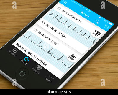 Mobile Gesundheit und Fitness app Herz EKG-Kurven für Vorhofflimmern Arrhythmie- und normalen Sinusrhythmus auf einem Apple Gerät. Stockfoto