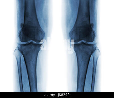 Arthrose, die beide Knie.  Film x-ray AP (anterior - posterior) Knie Show schmale Gelenkspalt. Osteophyten (Spur). Subcondral Sklerose. Stockfoto