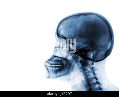 X-ray normal Schädel und Halswirbelsäule. Seitliche Ansicht. leeren Bereich auf der linken Seite. Stockfoto
