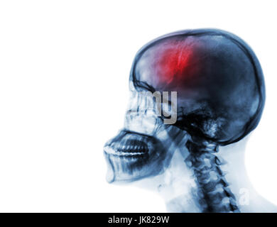 Schlaganfall. Apoplexie. Film x-ray menschlicher Schädel und Halswirbelsäule. leeren Bereich auf der linken Seite. Stockfoto
