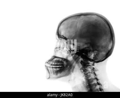 X-ray normal Schädel und Halswirbelsäule. Seitliche Ansicht. leeren Bereich auf der linken Seite. Stockfoto