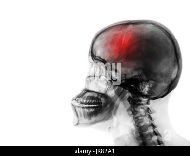 Schlaganfall. Apoplexie. Film x-ray menschlicher Schädel und Halswirbelsäule. leeren Bereich auf der linken Seite. Stockfoto