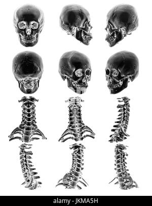CT-Scan (Computertomographie-Tomographie) mit 3D Grafik zeigen normale menschliche Schädel und Halswirbelsäule. Mehrere anzeigen. Stockfoto