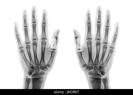 Sowohl der Roentgenfilm hand AP zeigen normale menschliche Hände auf weißem Hintergrund (isoliert). Stockfoto