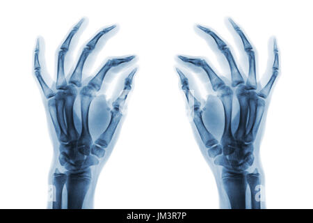 X-ray normale menschliche Hände auf weißem Hintergrund. Schrägansicht. Stockfoto