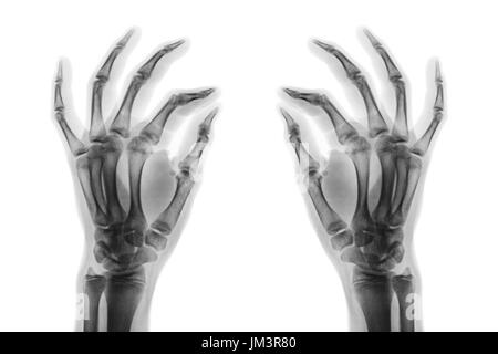 X-ray normale menschliche Hände auf weißem Hintergrund. Schrägansicht. Stockfoto