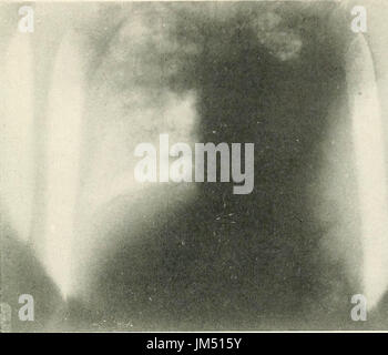 "Radio-Diagnose von Pleuro-pulmonale Zuneigung" (1918) Stockfoto