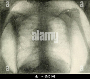 "Radio-Diagnose von Pleuro-pulmonale Zuneigung" (1918) Stockfoto