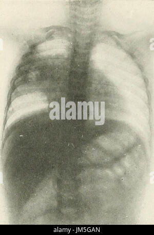 "Radio-Diagnose von Pleuro-pulmonale Zuneigung" (1918) Stockfoto