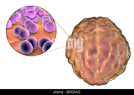 Meningitis verursacht durch Bakterien Neisseria Meningitidis, Computer Bild. Die Abbildung zeigt die Schwellung der Hirnhäute und Nahaufnahme von Bakterien N. Meningitidis. Stockfoto