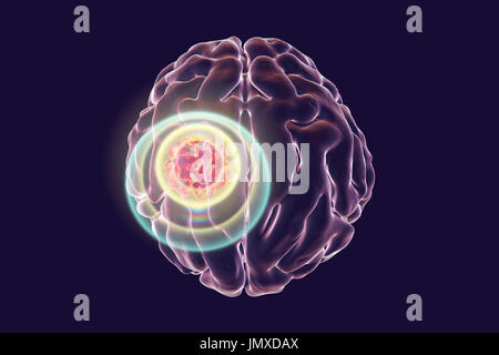 Konzeptbild für Gehirn-Krebs-Behandlung. Computer-Darstellung, die Zerstörung von Hirntumor. Stockfoto