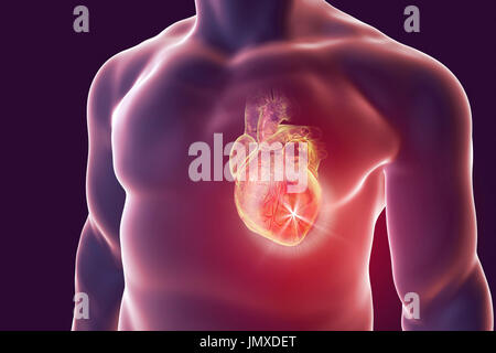 Herzinfarkt, konzeptionelle Computer Illustration. Stockfoto