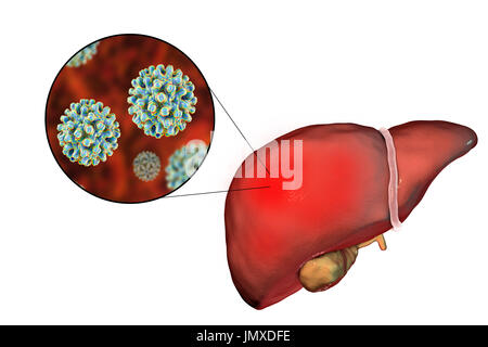 Leber mit Hepatitis und Nahaufnahme Blick auf Hepatitis B-Viren, Abbildung. Stockfoto