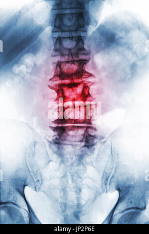 Spondylose.  Film x-ray lumbosakralen Wirbelsäule im Alter von alten Patienten zeigen Osteophyten, Zusammenbruch Wirbelsäule von degenerativen Prozess. Ansicht von vorne. Stockfoto