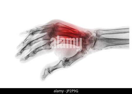 Bruch am 3. und 4. Mittelhandknochen. Der Roentgenfilm Erwachsene Hände. Schrägansicht. Stockfoto