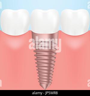 Zahnimplantat menschlichen isoliert auf einem Hintergrund. Vektor-Illustration. Stock Vektor