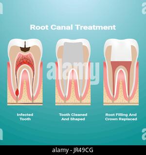 Pulpitis. Wurzelbehandlung. Infizierte Zellstoff wird vom Zahn entfernt und der Raum von ihm besetzt wird gereinigt und gefüllt mit einem Gutta Percha isoliert auf einem Hintergrund. Vektor-Illustration. Stock Vektor