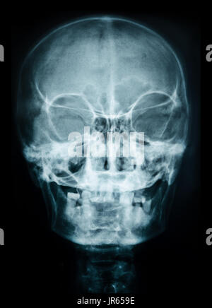 X-ray von Schädel Mensch. Stockfoto