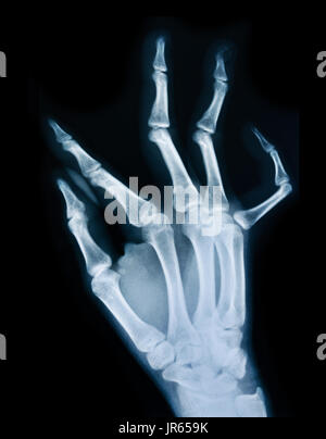 X-ray von einer menschlichen Hand. Stockfoto