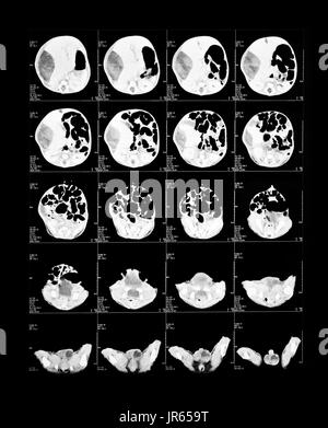 X-ray Image des Gehirns Computertomographie (Gehirn) Stockfoto