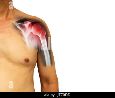 Menschliche Schulter mit x-ray Bruch am Hals des Humerus (Arm). Isolierte Hintergrund. Leeren Bereich auf der rechten Seite. Stockfoto