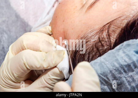 Dermatologe Chirurg fügt Polymilchsäure Filamente lifting Gesicht-selektiven Fokus auf durchführen. Stockfoto