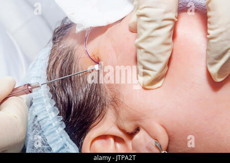 Dermatologe Chirurg fügt Polymilchsäure Filamente lifting Gesicht-selektiven Fokus auf durchführen. Stockfoto