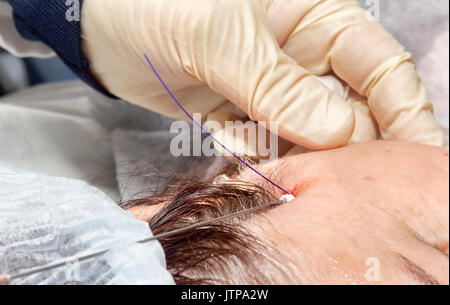 Dermatologe Chirurg fügt Polymilchsäure Filamente lifting Gesicht-selektiven Fokus auf durchführen. Stockfoto