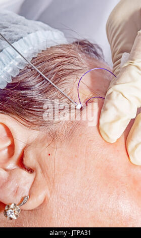 Dermatologe Chirurg fügt Polymilchsäure Filamente lifting Gesicht-selektiven Fokus auf durchführen. Stockfoto