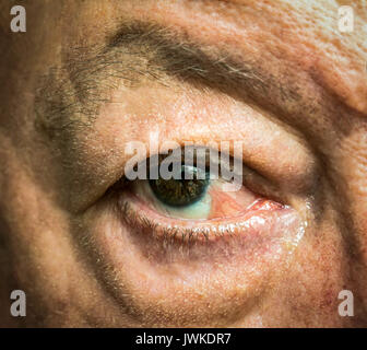 In der Nähe des Auges mit pseudopterygium nach einem Jahr der Bindehaut Plattenepithelkarzinom chirurgische Entfernung Stockfoto